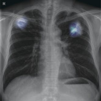 X-ray based tuberculosis scoring and monitoring solution 