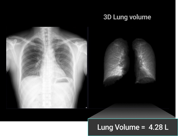 lung_03