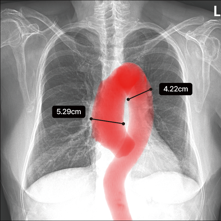 Aorta analysis example labeled needs attention