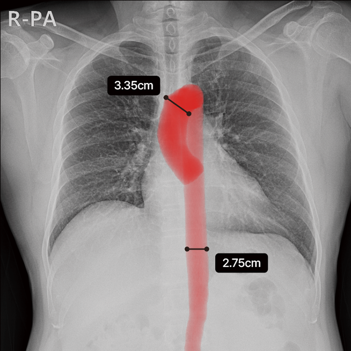 Aorta analysis example labeled normal