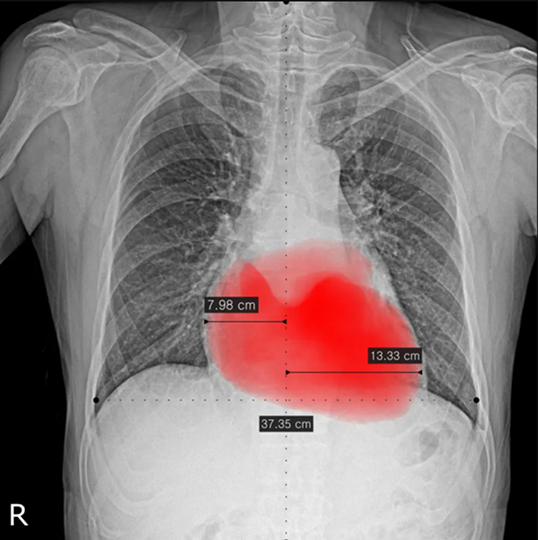 Heart size and CTR analysis example labeled needs attention