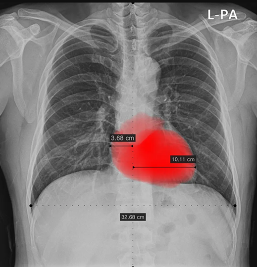 Heart size and CTR analysis example labeled normal