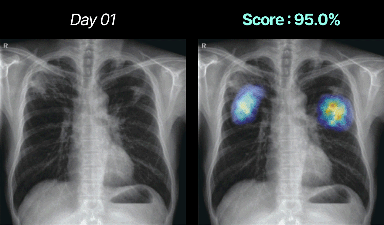TB abnormality score and heatmap